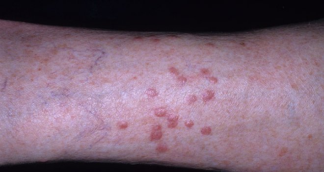 Böcek Isırıklarında Bunları Yapmayın