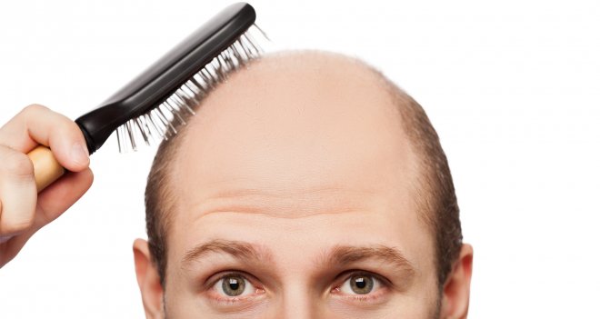 Erkeklerde saç dökülmesinin sebebi testosteron
