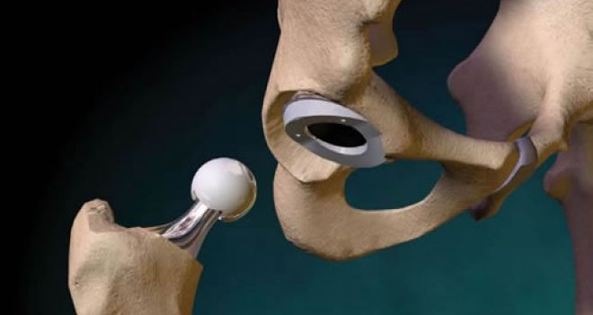 Kalça protezinden önce önleminizi alın 