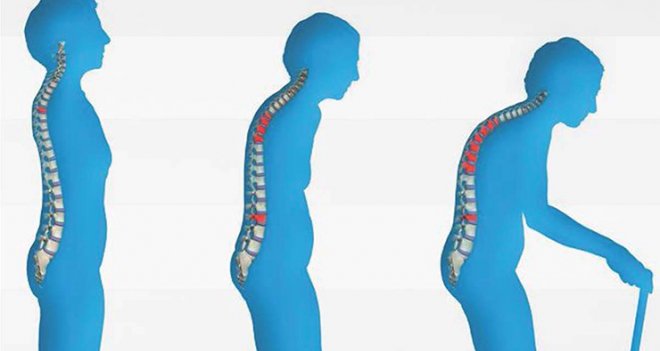 Menopoz sonrası kemik taramasını ihmal etmeyin