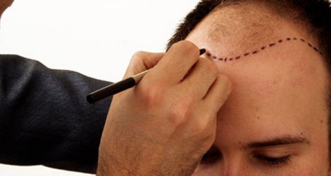 Saç ekimi 4 mevsim yapılabiliyor