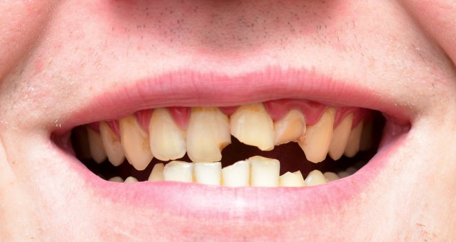Sağlıksız dişler hastalıklara davetiye çıkarıyor