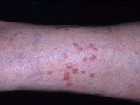 Böcek Isırıklarında Bunları Yapmayın