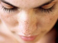 Çillilere Cilt Kanseri Uyarısı