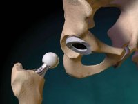 Kalça protezinden önce önleminizi alın 