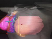 Prof.Görken: Radyoterapi korkulacak bir yöntem değildir