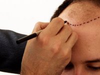 Saç ekimi 4 mevsim yapılabiliyor