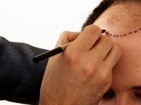 Saç ekiminden sonra kurallara uymak önemli