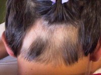 Saçkıran'ın tedavisi mümkün