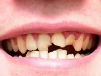 Sağlıksız dişler hastalıklara davetiye çıkarıyor