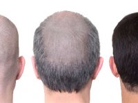 Sıcak havalar saç ekimine engel değil